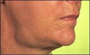 くび・顔の病気について  おぎわら耳鼻咽喉科クリニック